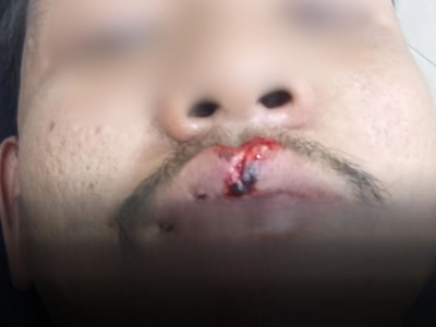 芭堤雅意外：鹿冲路摩托翻车，车手受伤缝八针