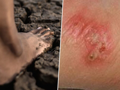 泰国发布公共卫生预警：类鼻疽确诊732例，23人死亡