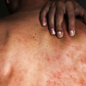 警讯！泰国2025学生HIV感染1.3万例