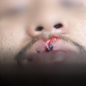 芭堤雅意外：鹿上公路导致摩托翻车，车手受伤缝八针