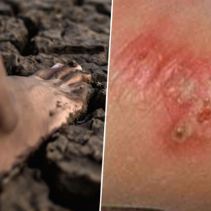 泰国发布公共卫生预警：类鼻疽确诊732例，23人死亡